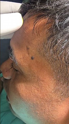 Nevus Treatment