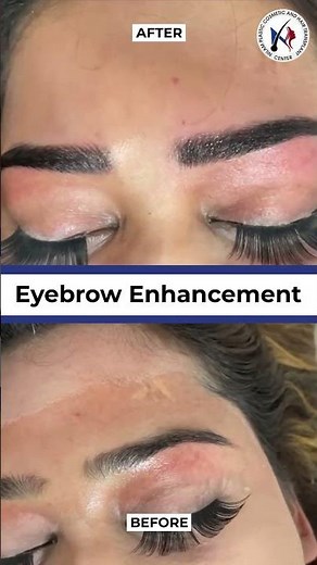 Redefine Your Brows with Microblading| Eyebrow Enhancement Transformation | Nilam Skin Clinic Ranchi