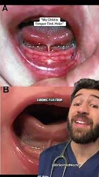 Baby Has a Tongue Tie? Doctor Explains