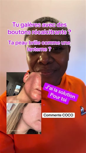 L’ACNÉ HORMONALE N’EST PAS UNE FATALITÉ Quand les boutons s’installent, qu’ils reviennent sans arrêt et que la peau brille… on a souvent l’impression d’avoir tout essayé. Mais la réalité, c’est qu’une peau ne se transforme pas avec un seul produit miracle. Les vrais résultats arrivent quand on agit à l’intérieur ET à l’extérieur. C’est exactement ce que j’ai mis en place avec mes clientes : un collagène marin de haute qualité pour soutenir la peau de l’intérieur une routine skincare adaptée pour