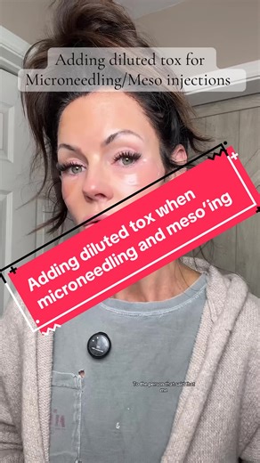 In my opinion adding in the diluted tox for my Microneedling solution and Meso injections was very beneficial….. hello glow!!!@AceCosm #microneedling #mesotherapy #diyinjections #mesowithtox #diyinjector