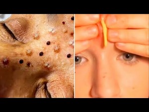 Popping Giant Pimple & Popping Huge Blackheads - Best Pimple Popping Video #62