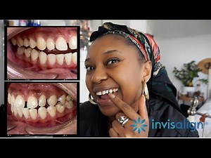 I'm fixing my underbite but keeping my Gap Teeth (diastema)| Invisalign Journey #1