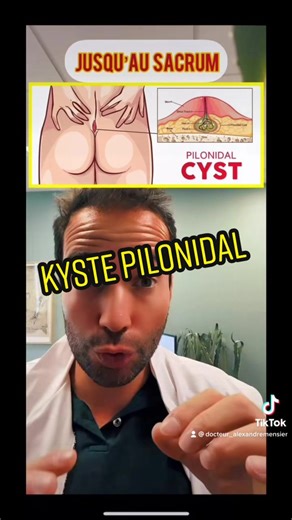 Le kyste pilonidal !? #foryou #pourtoi #foryoupage #fry #fakebody #fakeblood #pilonidalcyst @Chirurgien viscéral & digestif
