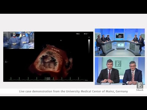 PASCAL repair system - Innovations in mitral valve repair | Edwards Lifesciences symposium