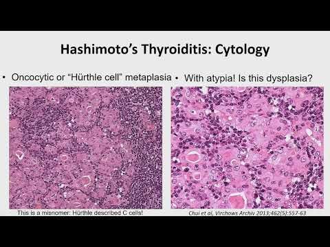 2023 Classic Lectures in Pathology: What You Need to Know: Endocrine Pathology