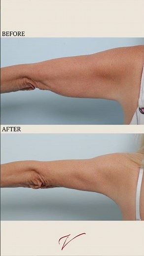 Arm Lift Scars Explained (What You Need to Know)