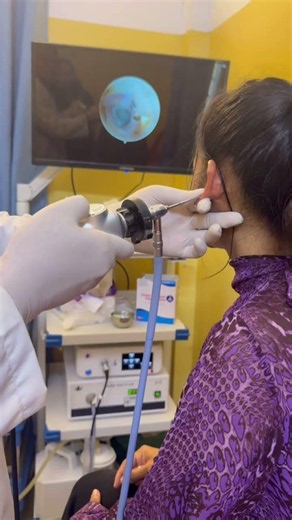 Extreme Earwax Removal 😱 | Thick Ear Plug Cleared Fast #earhealth #doctor #viral