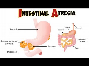 Intestinal atresia & stenosis