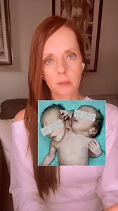 Info from StatPearls: ✔️Conjoined twins refers to twins that are physically fused in utero and consequently at birth. ➡️It happens when a monozygotic twin pregnancy cleaves more than 13 days after fertilization. ➡️They are monochorionic (one placenta) and monoamniotic (one amniotic sac). ➡️They exist in a female to male ratio of 3 to 1. ✔️Conjoined twins can be broadly categorized into non-dorsally conjoined twins (which includes ventral, lateral, and caudal conjunction) and dorsally conjoined t