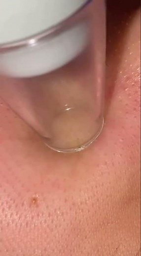 Is The Most Expensive Blackhead Tool WORTH IT? My Honest Pore Vacuum Review!