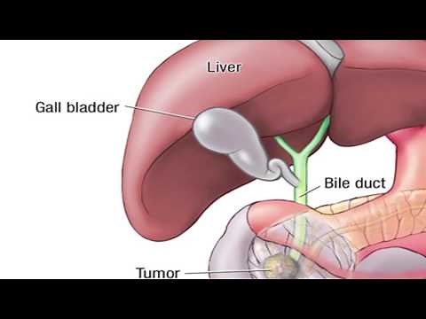 What is the Whipple Procedure - Mayo Clinic