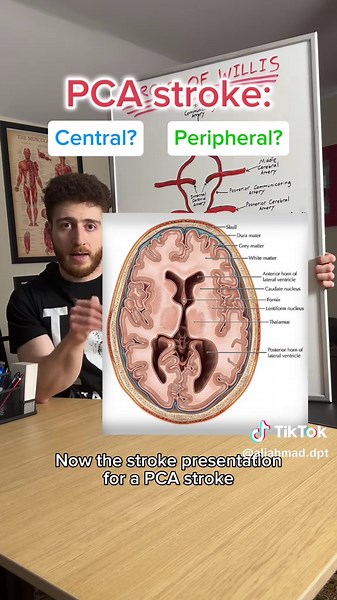 Understanding Posterior Cerebral Artery Strokes