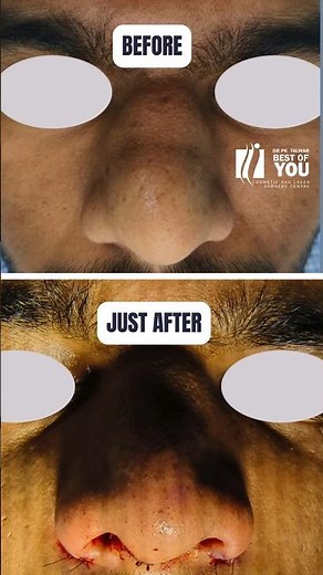 Tip Refinement Rhinoplasty Surgery, Before After Results of Nose Job Surgery in Delhi, Dr. PK Talwar