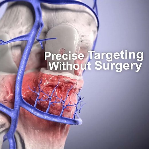 Medical animation explaining the Genicular Artery Embolization
