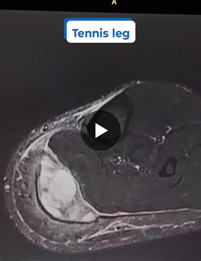 Tennis Leg MRI: Gastrocnemius Tear and Fluid Collection | Dr. Shubham Suryavanshi posted on the topic | LinkedIn