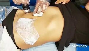 MICRONEEDLING FOR STRETCH MARKS AND SKIN TIGHTENING.