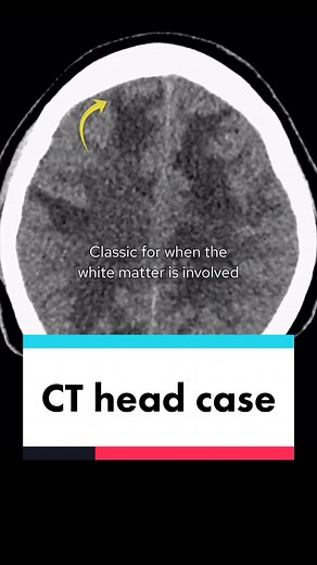 Understanding Brain CT Scans: Diagnosis and Techniques