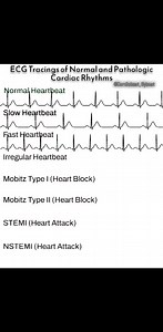 #ECG rythme normal et pathologique | Médecine générale