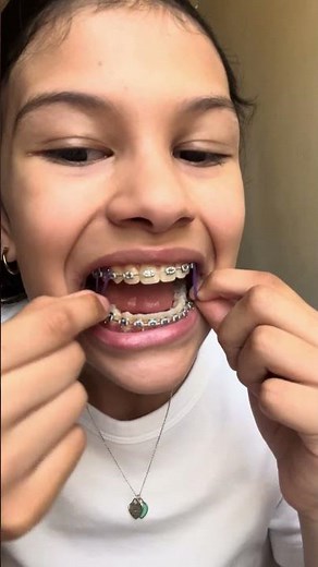 Putting on Purple Braces Rubber Bands on Light Blue Braces