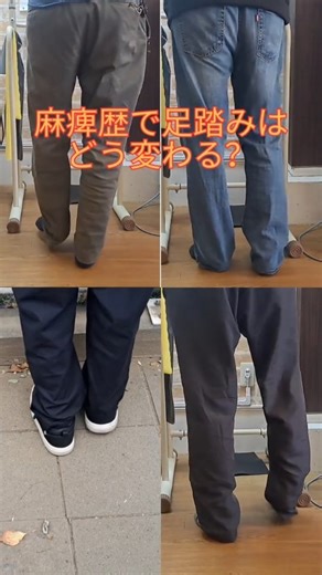 くまさんの整骨院 on Instagram: "片麻痺の足踏み動作の違いです。 麻痺歴 34年・4年・2年・2年 同じ「足踏み」でも 年数・状態によって動き方は大きく変わります。 「自分はもう良くならないのでは」と 不安に感じている方も多いですが、 変化が出る可能性はあります。 私自身も歩けない時期があり、 怖さや不安はよくわかります。 本編はYouTube https://youtu.be/YoYJ3kvqHnU #片麻痺 #脳卒中後遺症 #リハビリ #歩行訓練 #麻痺改善 くまさんの整骨院 埼玉県蕨市塚越1-18-6"