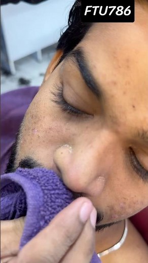 Blackhead #beforeafter #face #blackheadremoval #blackheadtreatment #deepcleansing #facetreatment
