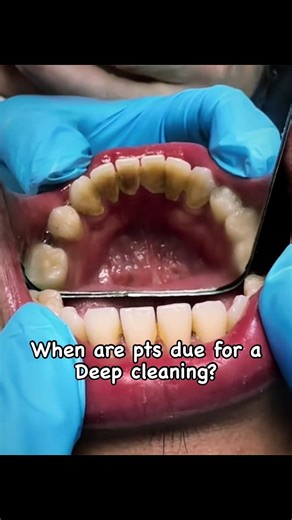 ✨𝐶𝐿𝐸𝐴𝑁𝐼𝑁𝐺• 𝑇𝐸𝐸𝑇𝐻 🦷 𝐼𝑇𝑆 𝐾𝐼𝑁𝐷𝐴 𝑀𝑌 𝑇𝐻𝐼𝑁𝐺 • ✨😁👌 You may be due for a deep cleaning 🧼 if : •It’s been 3 years since they’ve had a professional cleaning, or a dental check up. • present with heavy calculus and plaque build up • bleeding gums 🩸 • Bleeding on probing •5mm pocket depths • Radiographic calculus *** there can be other determining factors. It is important to educate the patient on coming to the dentist regularly, getting regular dental hygiene cleanings to a