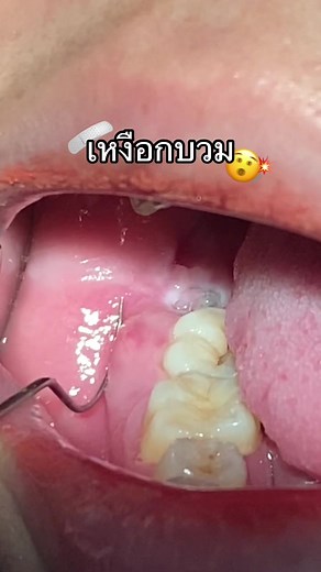 ฟันคุดและเหงือกบวม: อาการและการรักษา