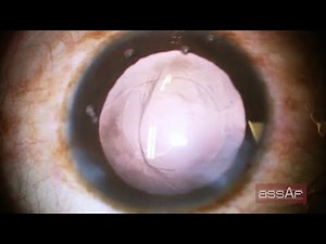Posterior Capsular Tear before IOL implantation. Ahmed Assaf