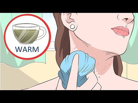 How to Get Rid of Neck Acne Overnight - Get Rid Of Neck Acne Fast And Easy | Neck acne