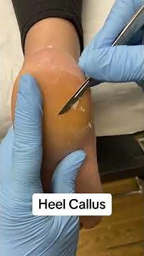 Satisfying Thick Heel Callus Removal by Podiatrist #FootCare #SatisfyingVideos