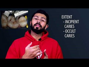 Various Classifications of Dental Caries