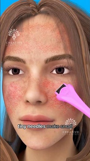 How Microneedling Works - Benefits of Derma roller #short #viralvideo - Creativelearning3d