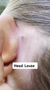 the top hotspots for head louse is behind the ears. Because they get double the warmth #lice #momlife #hair #Piojos #explore | Stacey The Louse Lady