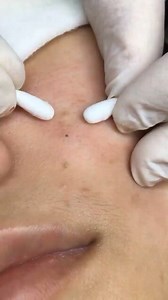 314K views · 422 reactions | Blackheads and acne removal | Daily medical videos | Facebook