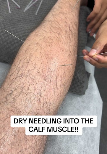 Effective Dry Needling Techniques for Calf Muscles
