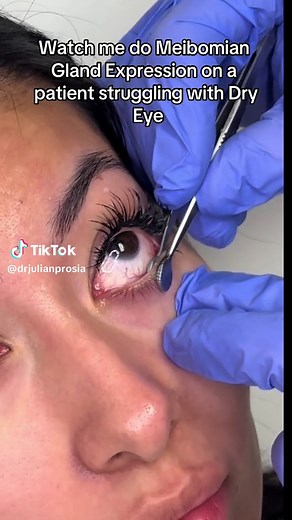 Meibomian Gland Expression for Dry Eye Treatment