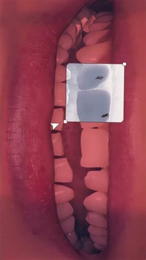 Chipped Tooth? Don’t Ignore This!