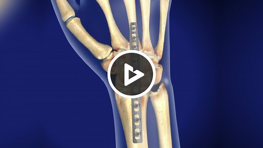 Wrist Fusion (Total Wrist Arthrodesis)