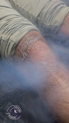 A local cryotherapy treatment involves exposing a specific area of the body to subzero temperatures, the skin drops down to about 50 degrees. The treatment is painless and takes 10 minutes. During the session, the skin temperature drops significantly and naturally warms right back up after the treatment accelerating the recovery time. 😇 Treatment : Local Cryo 🎯 Purpose: Minimize Pain, Reduce inflammation, promote natural healing. Great for knees, ankles backs, shoulders. 📞 Phone: 951.456.4518
