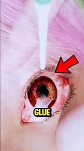 This Is What Happens When Super Glue Hits Your Eye — And the Only Safe Way to React!😱