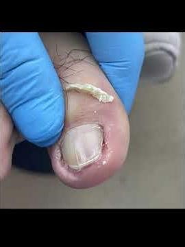 There Is Pus Under The Ingrown Toenail; Trim It Carefully! #nails