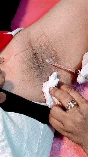 💉 Botox for Underarm Sweating | at Bhoumik Healthcare #UnderarmBotox #sweating #treatment