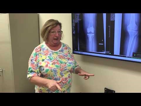 Total Knee Replacement 2 weeks after surgery