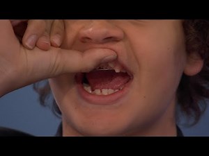 ‘Stranger Things’ Actor Shares about Life with Cleidocranial Dysplasia