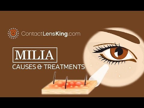 Milia Extraction Causes and Treatment | Milia Under the Eyes