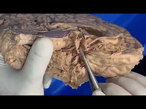 SYLVIAN FISSURE CADAVERIC Brain Dissection in Anatomy lab, to teach Neuro-anatomy, brain tracts