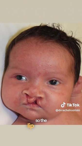 Hi 👋🏼 everyone! Today, I am discussing PLANA (Pre- surgical Lip Alveolus and Nose Approximation). This device is used to bring the lip segments closer together AND shape the nose BEFORE a baby’s cleft lip and nasal reconstruction. Not all cleft patients require PLANA, but the ones that do, have it in place for approximately 3-4 months leading up to their surgery. Watch 👀 the following video where I take you behind-the-scenes of a recent office visit for a #cleftcutie who is one month into her