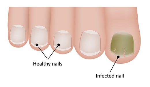 under toenail fungus - Toenail Fungus Treatment | Toenail Fungus Treatment