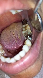 Impact of Smoking on Oral Health: Effects on Teeth and Gums